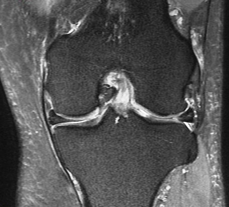 Figure 5 for case Root attachment tear of the posterior horn of the lateral meniscus (RID2763)